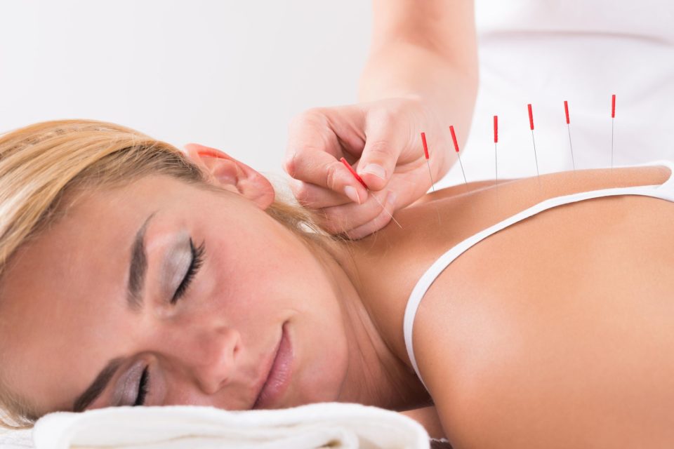 l’acupuncture